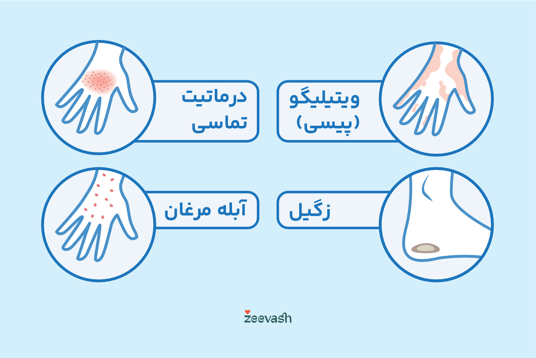 عکس بیماری پوستی - زگیل ویتیلیگو آبله مرغان درماتیت تماسی